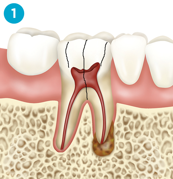 Dental implant diagram step 1