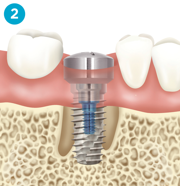 Dental implant diagram step 2