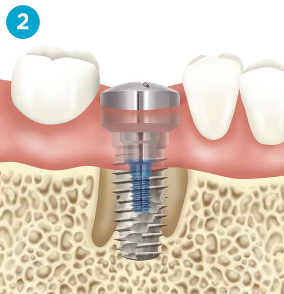 Dental implant diagram step 2