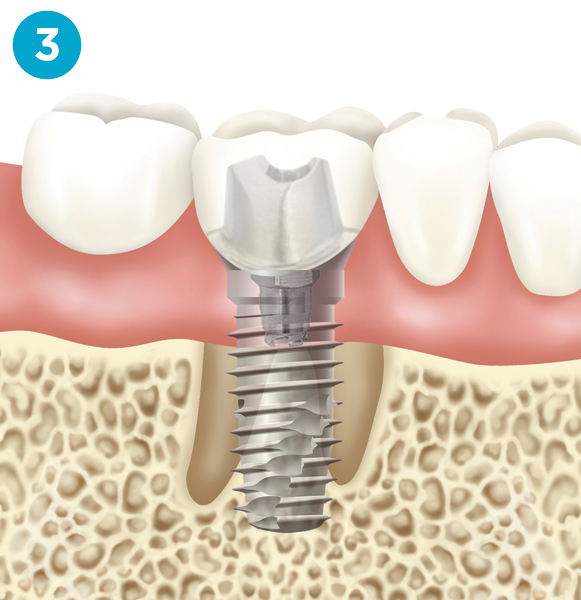 Dental implant diagram step 3