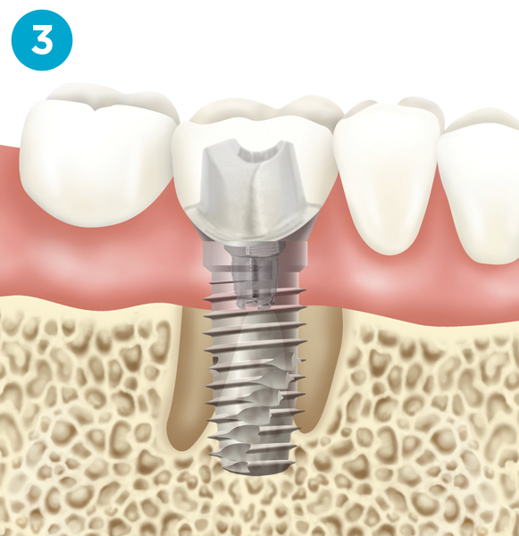 Dental implant diagram step 3